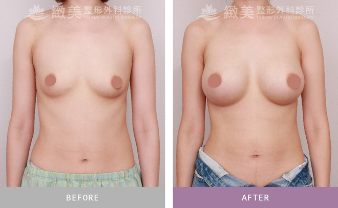 水滴型果凍矽膠隆乳 術後3個月