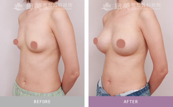 水滴型果凍矽膠隆乳 術後3個月