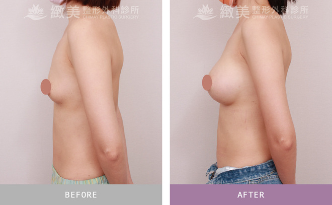 水滴型果凍矽膠隆乳 術後3個月