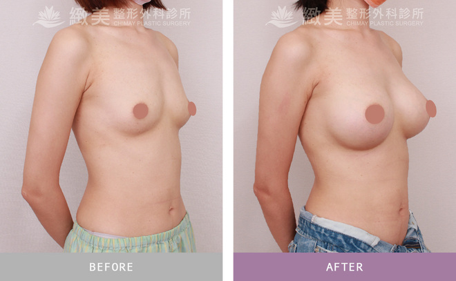 水滴型果凍矽膠隆乳 術後3個月