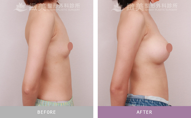 水滴型果凍矽膠隆乳 術後3個月