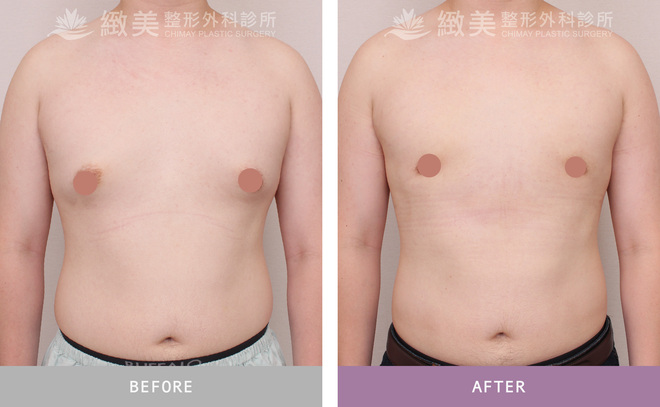 男性女乳矯正術後 1個月