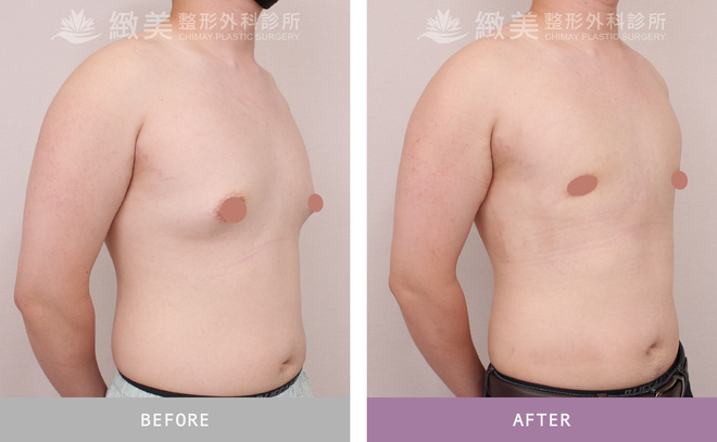 男性女乳矯正術後 1個月