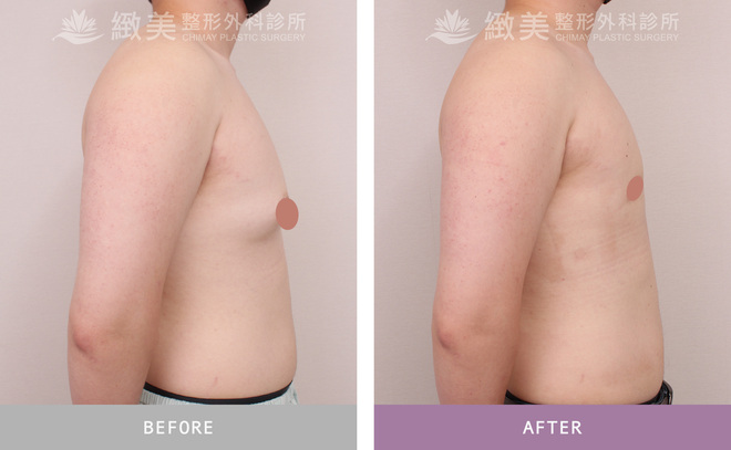 男性女乳矯正術後 1個月