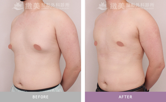 男性女乳矯正術後 1個月