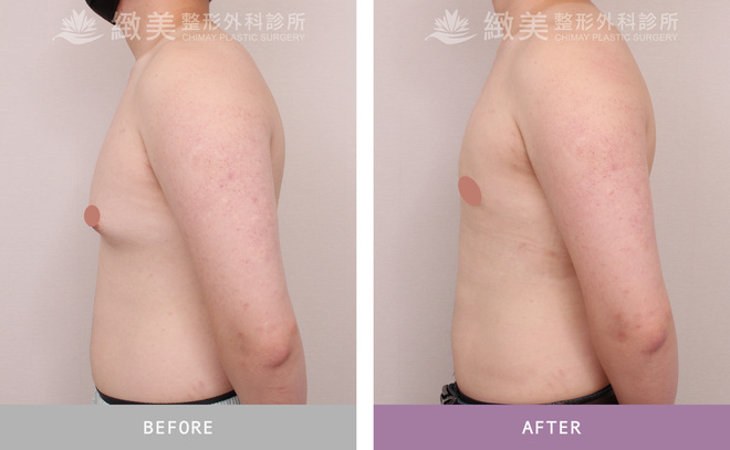 男性女乳矯正術後 1個月