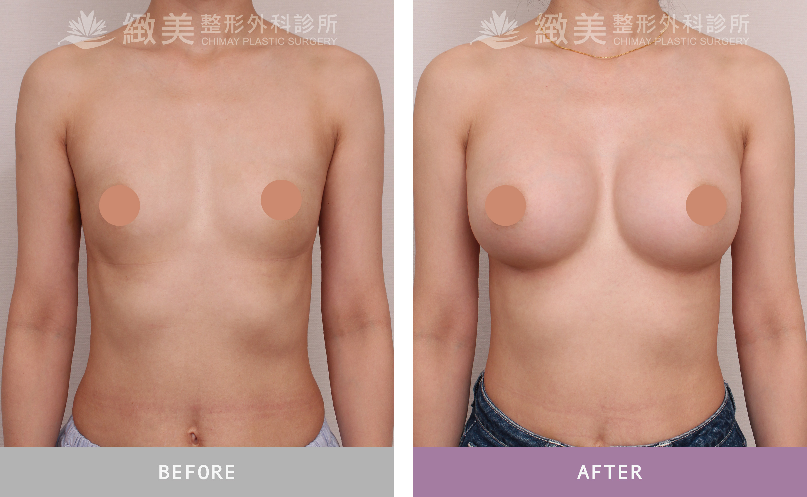 水滴型果凍矽膠隆乳 術後3個月