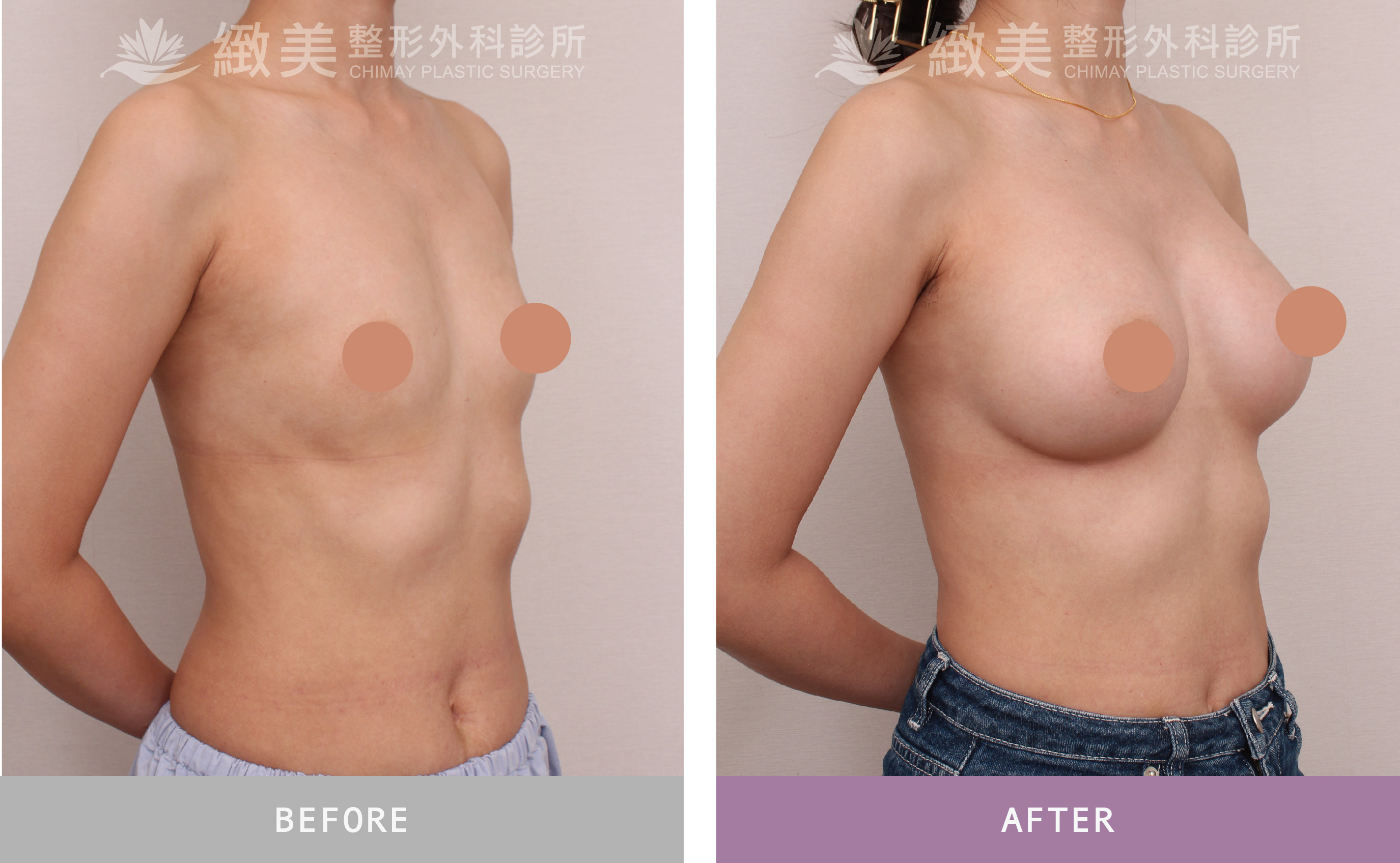 水滴型果凍矽膠隆乳 術後3個月