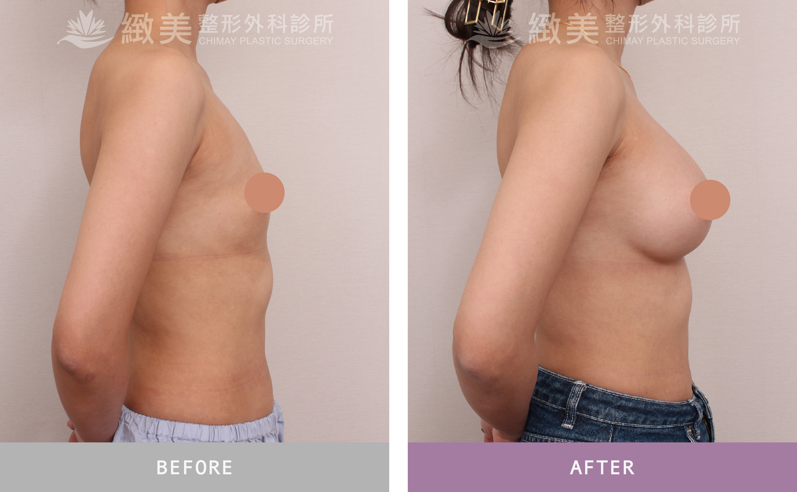 水滴型果凍矽膠隆乳 術後3個月