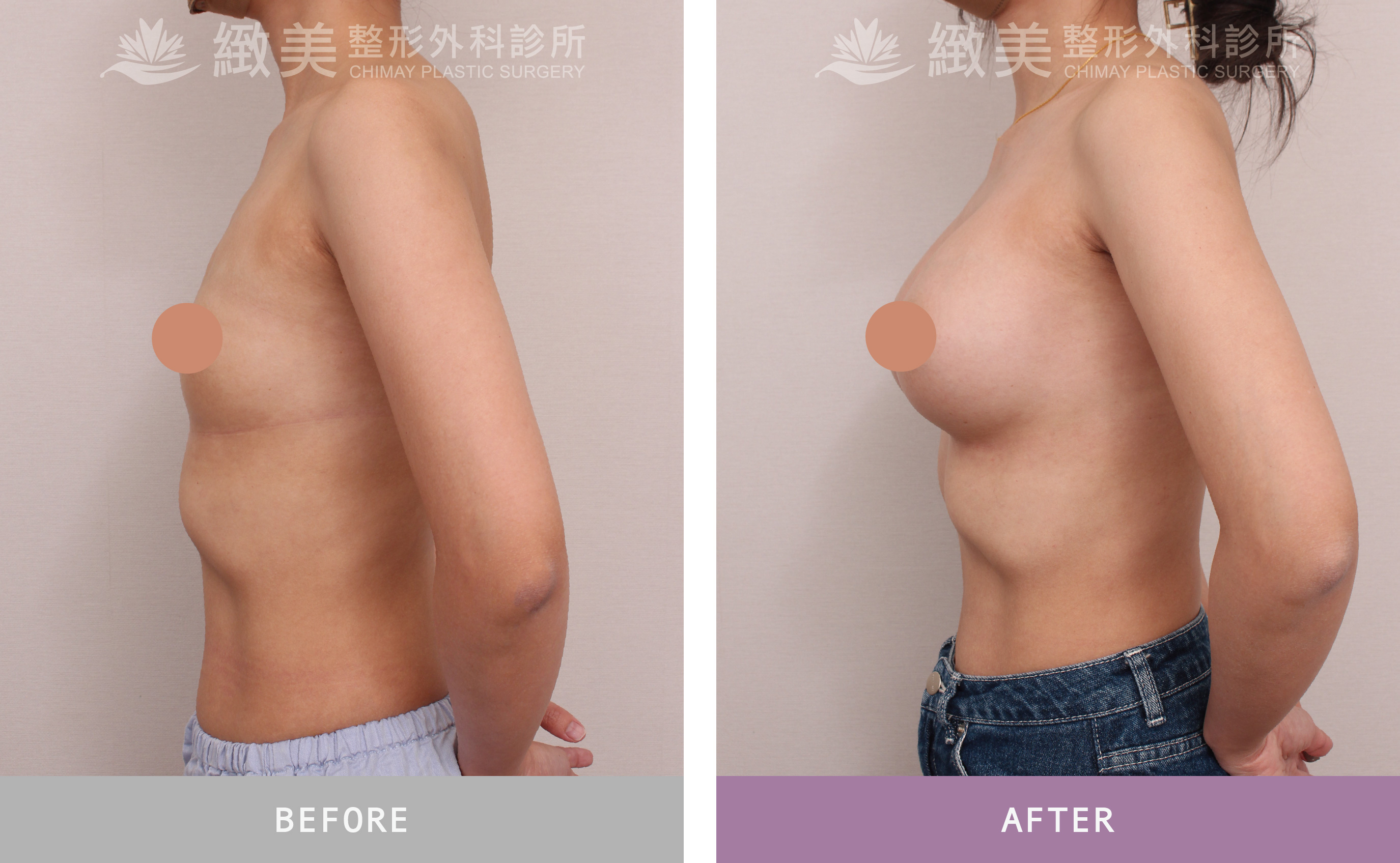 水滴型果凍矽膠隆乳 術後3個月