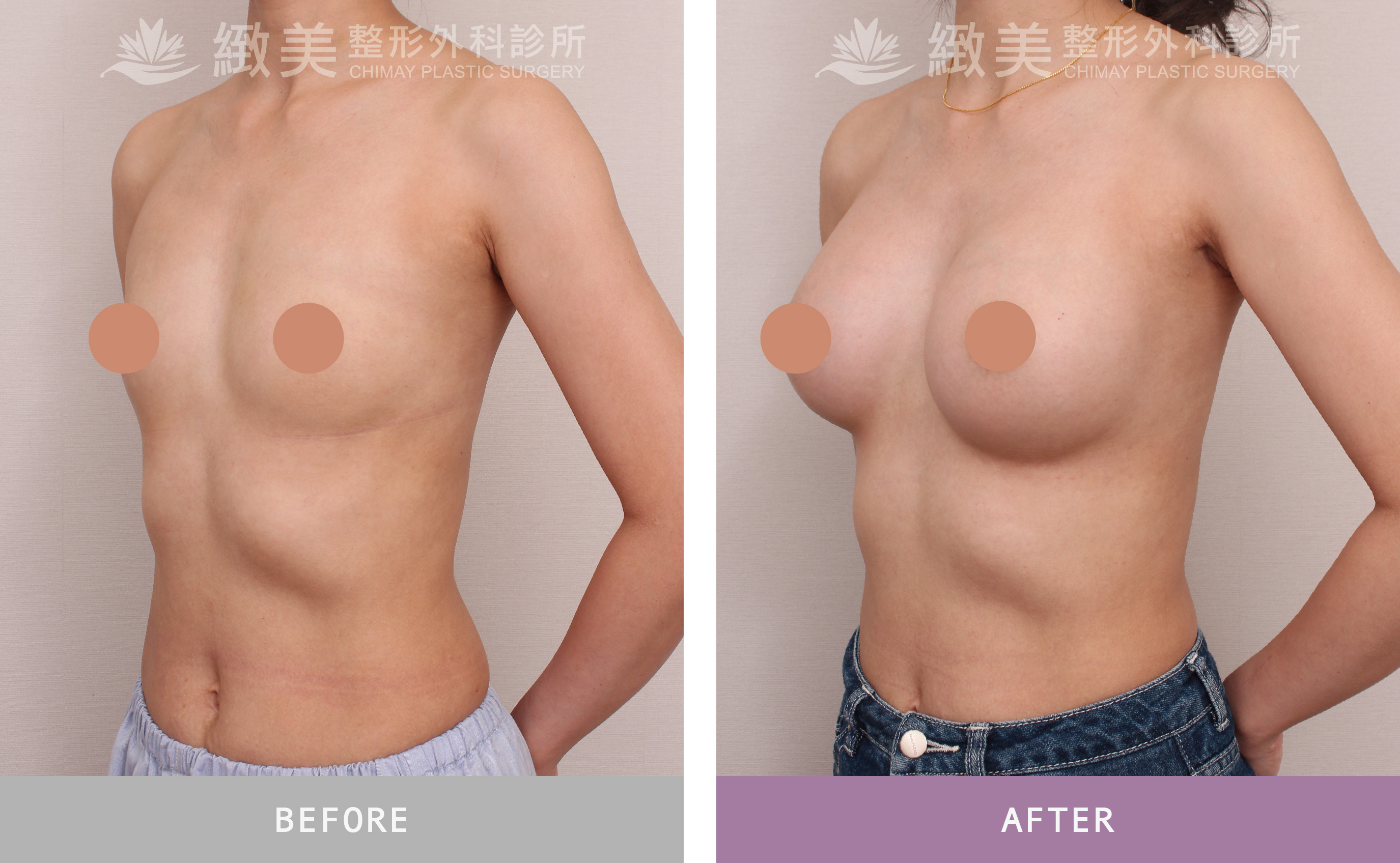 水滴型果凍矽膠隆乳 術後3個月